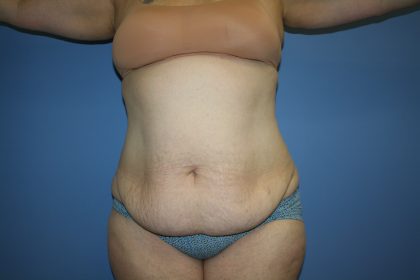 Tummy Tuck Before & After Patient #5667