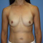 Breast Augmentation Before & After Patient #5669