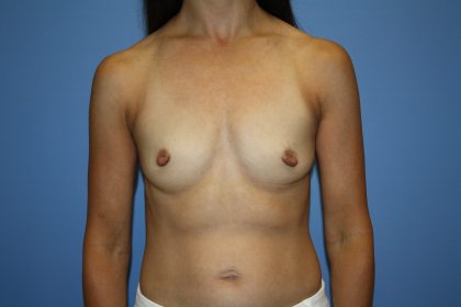 Breast Augmentation Before & After Patient #5669