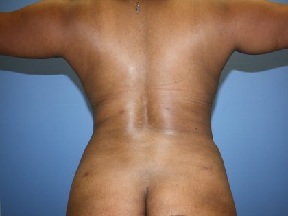 Liposuction Before & After Patient #5670