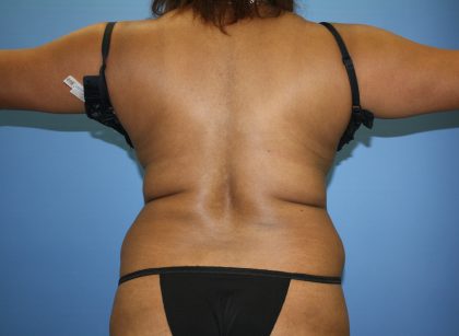 Liposuction Before & After Patient #5670