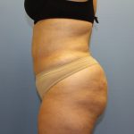 Brazilian Butt Lift Before & After Patient #5671