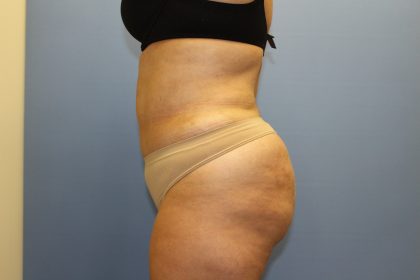 Brazilian Butt Lift Before & After Patient #5671