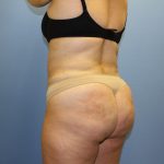 Brazilian Butt Lift Before & After Patient #5671