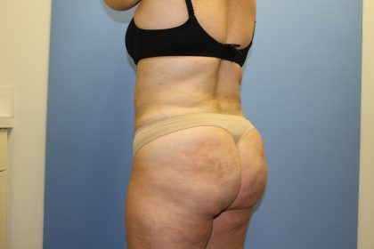 Brazilian Butt Lift Before & After Patient #5671