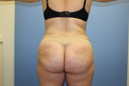 Tummy Tuck Before & After Patient #5671