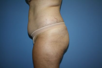 Brazilian Butt Lift Before & After Patient #5671
