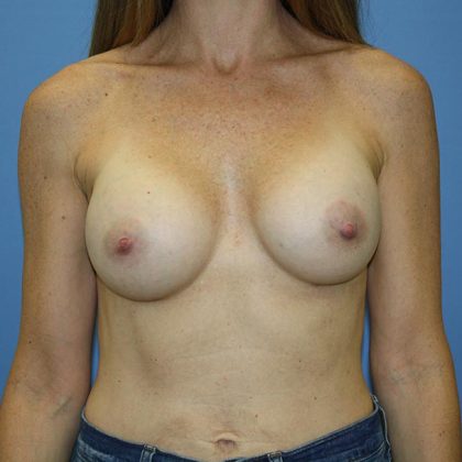 Breast Augmentation Before & After Patient #5673