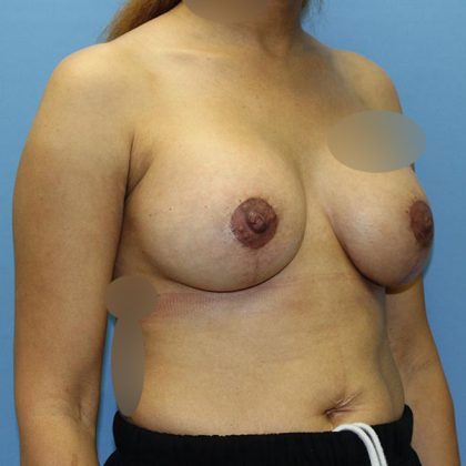 Breast Lift with Implant Before & After Patient #5674
