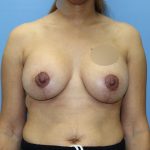 Breast Lift with Implant Before & After Patient #5674