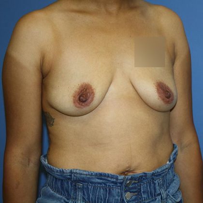 Breast Lift with Implant Before & After Patient #5674