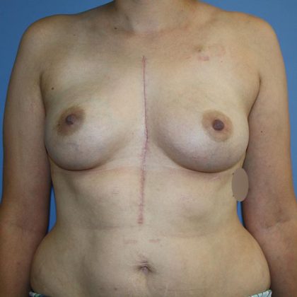 Breast Reconstruction Before & After Patient #5698
