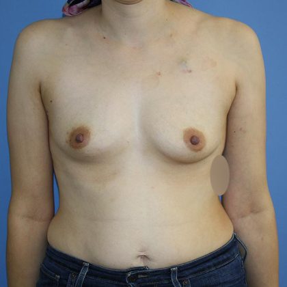 Breast Reconstruction Before & After Patient #5698