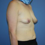 Breast Lift with Implant Before & After Patient #5701