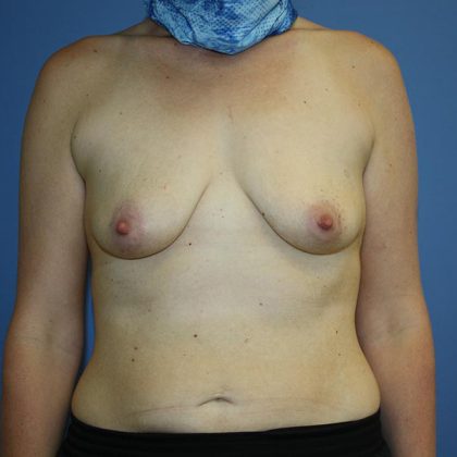 Breast Lift with Implant Before & After Patient #5701