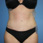 Tummy Tuck Before & After Patient #5702