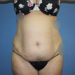 Tummy Tuck Before & After Patient #5702