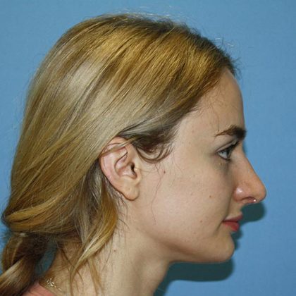 Nose Surgery Before & After Patient #5728
