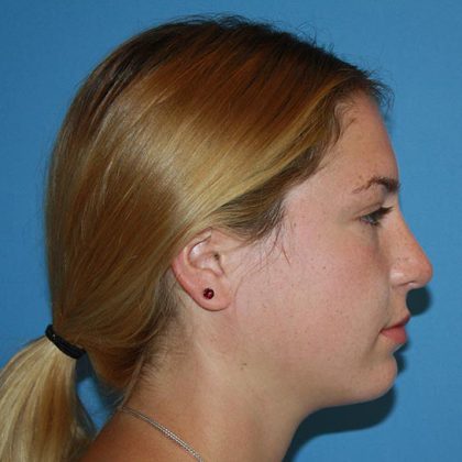 Nose Surgery Before & After Patient #5729
