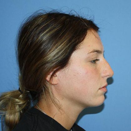 Nose Surgery Before & After Patient #5729