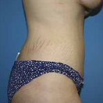 Tummy Tuck Before & After Patient #5730