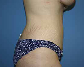 Tummy Tuck Before & After Patient #5730