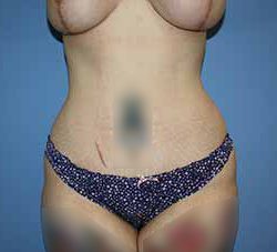 Tummy Tuck Before & After Patient #5730