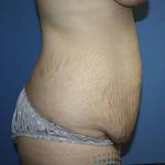 Tummy Tuck Before & After Patient #5730