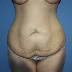 Tummy Tuck Before & After Patient #5730