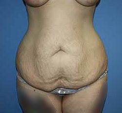 Tummy Tuck Before & After Patient #5730