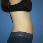 Tummy Tuck Before & After Patient #5749