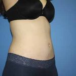 Tummy Tuck Before & After Patient #5749