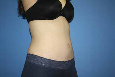 Tummy Tuck Before & After Patient #5749