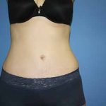 Tummy Tuck Before & After Patient #5749