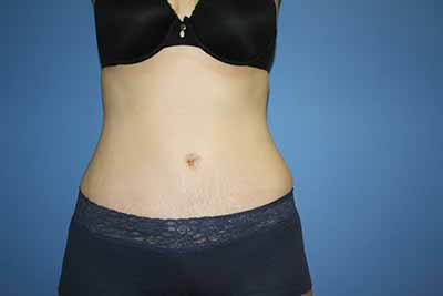 Tummy Tuck Before & After Patient #5749