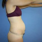 Tummy Tuck Before & After Patient #5749