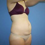 Tummy Tuck Before & After Patient #5749