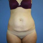 Tummy Tuck Before & After Patient #5749