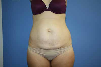Tummy Tuck Before & After Patient #5749