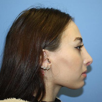 Nose Surgery Before & After Patient #5750