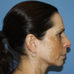 Nose Surgery Before & After Patient #5579