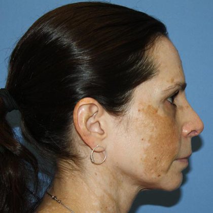 Nose Surgery Before & After Patient #5579