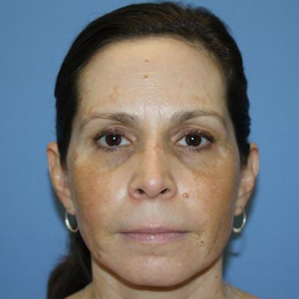 Facelift Before & After Patient #5579