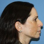 Nose Surgery Before & After Patient #5579