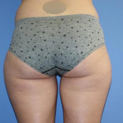 Liposuction Before & After Patient #5592