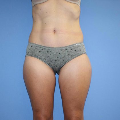 Brazilian Butt Lift Before & After Patient #5592