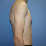 Gynecomastia Before & After Patient #5593