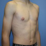 Gynecomastia Before & After Patient #5593