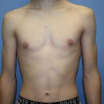 Gynecomastia Before & After Patient #5593