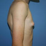 Gynecomastia Before & After Patient #5593